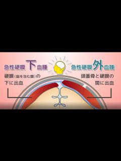 [x]「急性硬膜下血腫・急性硬膜外血腫」 - YouTube