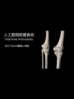 [x]人工膝関節置換術・TKAの種類と特徴 - YouTube