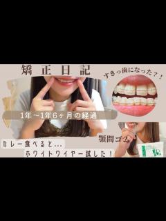 [x]矯正1年~1年半の変化/額間ゴム/奮闘記録🔥 - YouTube